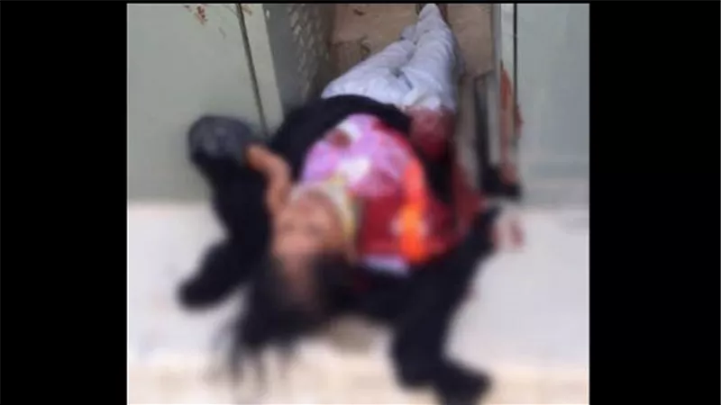 امرأة تقطع ذراعها وقدمها لتحصل على مكافأة التأمين الصحي