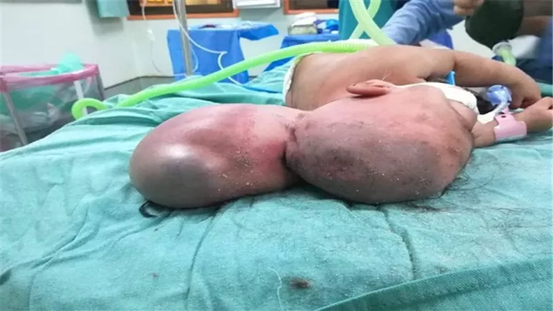 بالصور.. إستئصال كيس مائي وتقويم عظام الجمجمة لطفل في الشهر الثاني من العمر بمستشفى المنصورة الدولي بالدقهلية