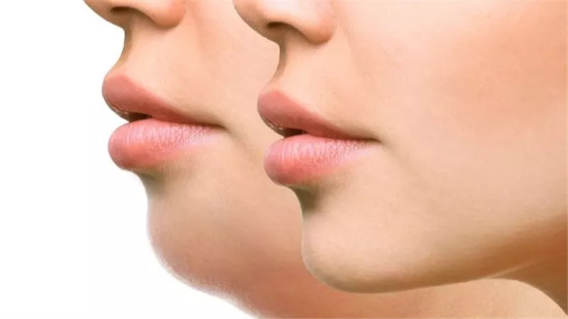 للسيدات فقط.. سبب ظهور الشعر في هذه المنطقة