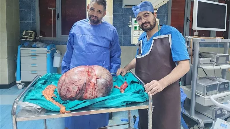 بمهارة فريق طبي مصري.. استئصال ورم مبيضي عملاق يزن 24 كيلو بالمنيا