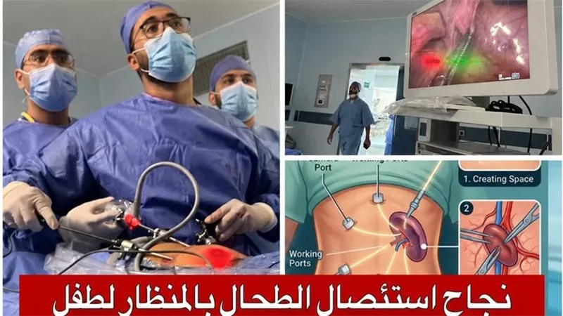 إنجاز طبي جديد بجامعة قناة السويس.. نجاح أول عملية استئصال كامل للطحال بالمنظار لطفل